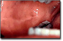 Buccal Mucosa - La muqueuse buccale