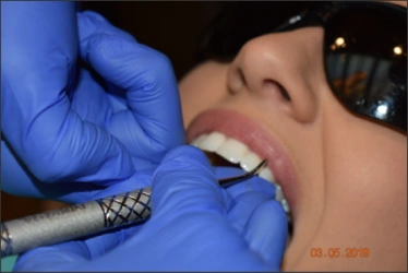 Figure 63 : une photo d’une bouche ouverte montrant la méthode du point d’appui doigt sur doigt