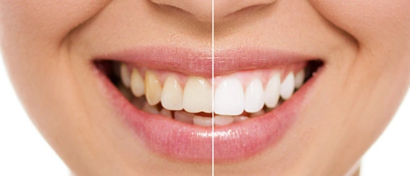 Whitening