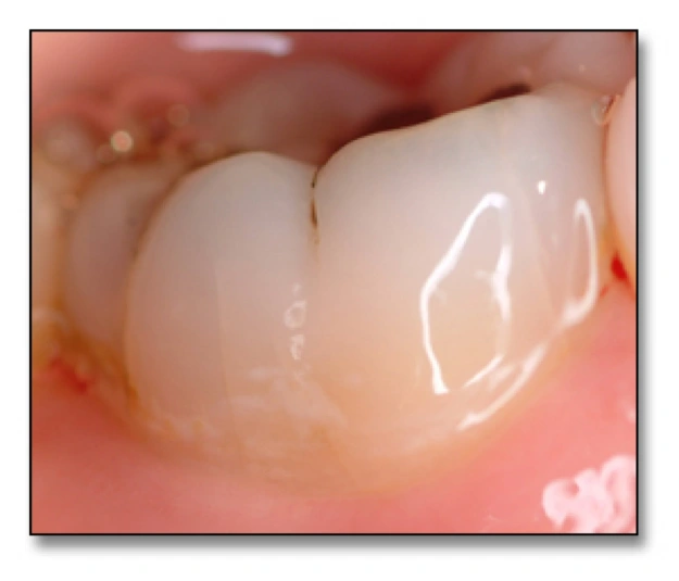 Surfaces at Risk for Caries - Figure 3