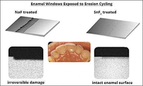 Dental Erosion - Figure 1