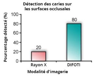 Graphique de détection des caries sur les surfaces occlusales.