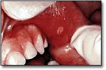 Aphthous Ulcers - Figure 1