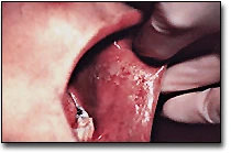 Buccal Mucosa - Chronic Cheek Biting