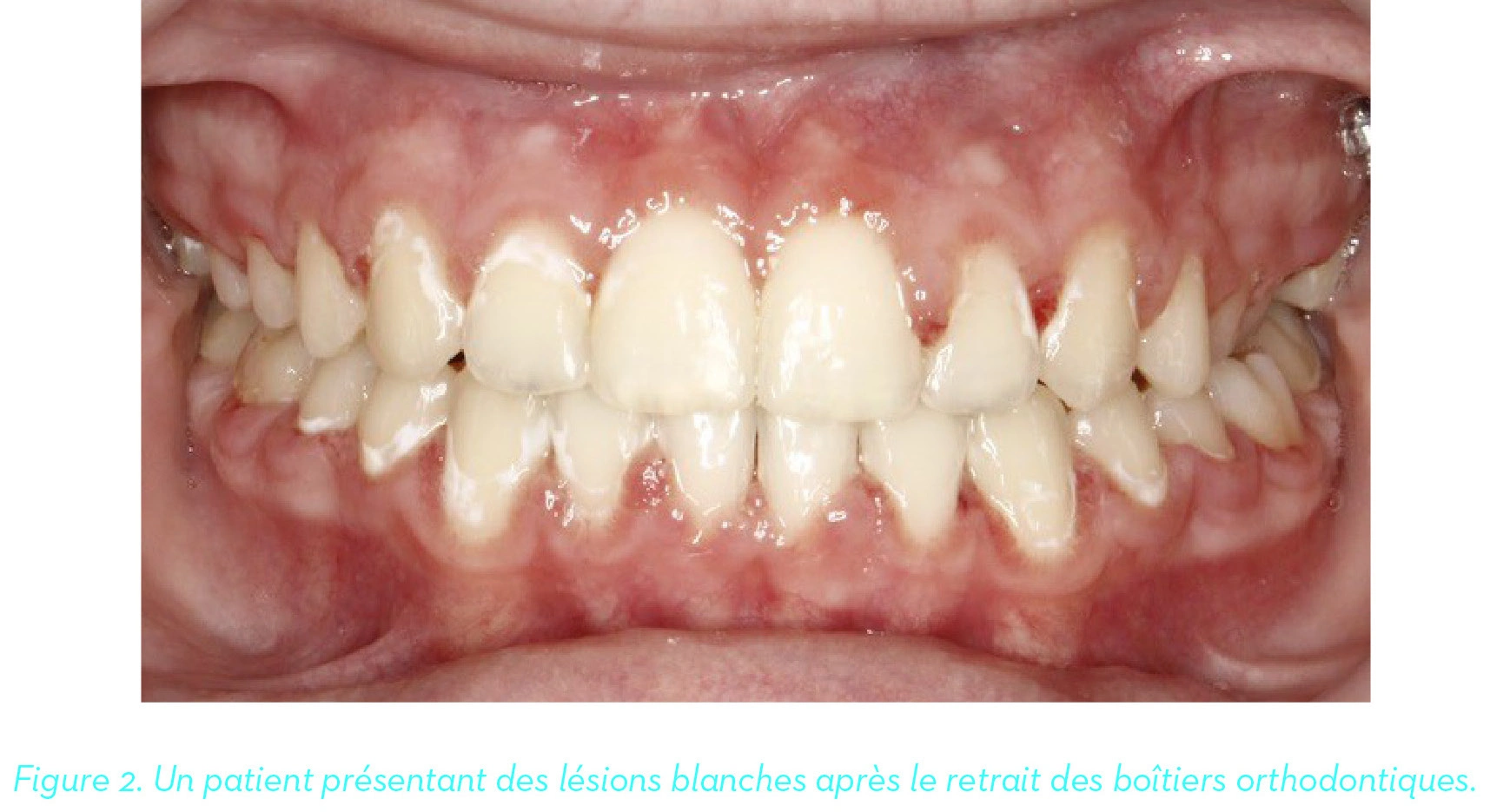 Un patient présentant des lésions blanches après le retrait des boîtiers orthodontiques.