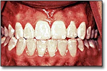 ce4 - Content - Discolored Teeth - Mild Fluorosis