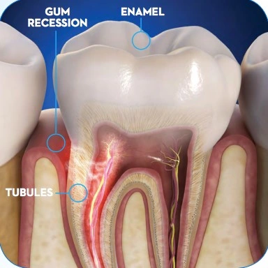  Patient Material - 敏感牙齿 – 原因和疗法 - Sensitive Teeth – Causes And Treatment - Chinese - Image 1