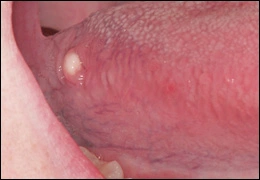 Lymphoepithelial cyst
