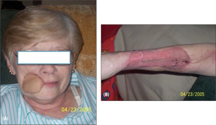 Photo montant le visage du patient après la greffe de peau et le bras d’où la greffe a été prélevée