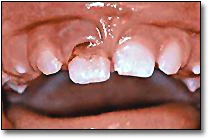 Les blessures aux dents primaires - Blessures à une incisive primaire