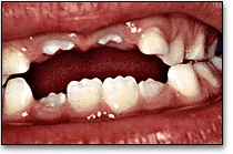 Modèle d’éruption - Dents permanentes - Figure 2