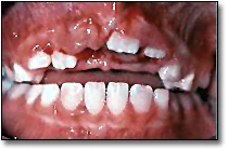 Dents permanentes intrudées - Figure 3