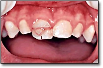 Les blessures aux dents primaires - Dent primaire fracturée