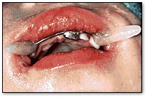 Oral Electrical Injuries - Commissure Splint in Place