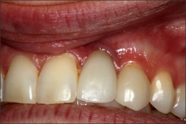 Photo montrant un exemple d’implants dentaires
