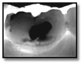 Image de caries détectées à l'aide du système DIFOTI.