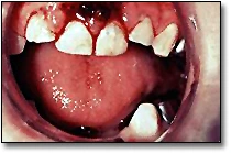  Les blessures aux dents primaires - Dents primaires déplacées