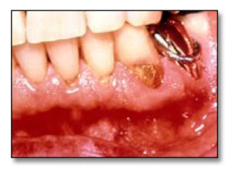 Images illustrant les risques associés à la carie dentaire.