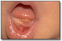 Common Congenital Conditions in Newborns - Dental Lamina Cyst