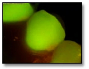 Image illustrant un examen clinique réalisé avec le système QLF montrant une auto-fluorescence verte sur les surfaces buccales et une fluorescence rouge dans les régions proximales.