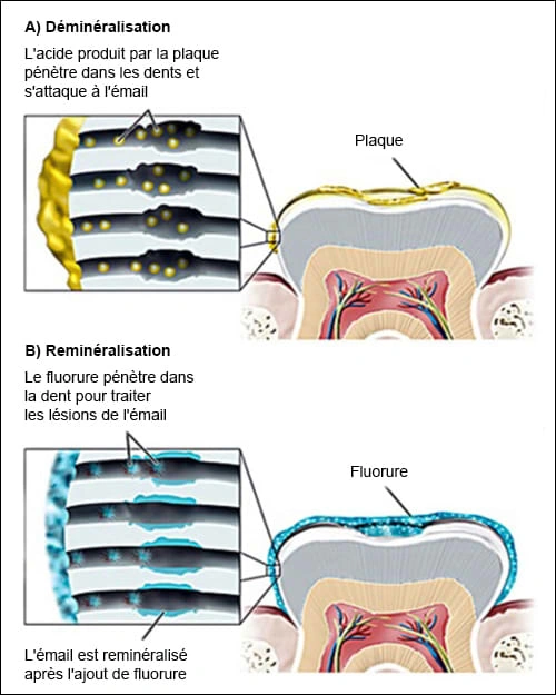 
Figure 5. Déminéralisation et reminéralisation. 