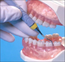 La figure 18 montre un modèle de dents et de gencives sondées par une curette Gracey 13/14