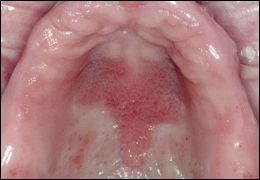 Inflammatory papillary hyperplasia