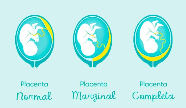 Placenta Prévia: O Que É E O Que Fazer?