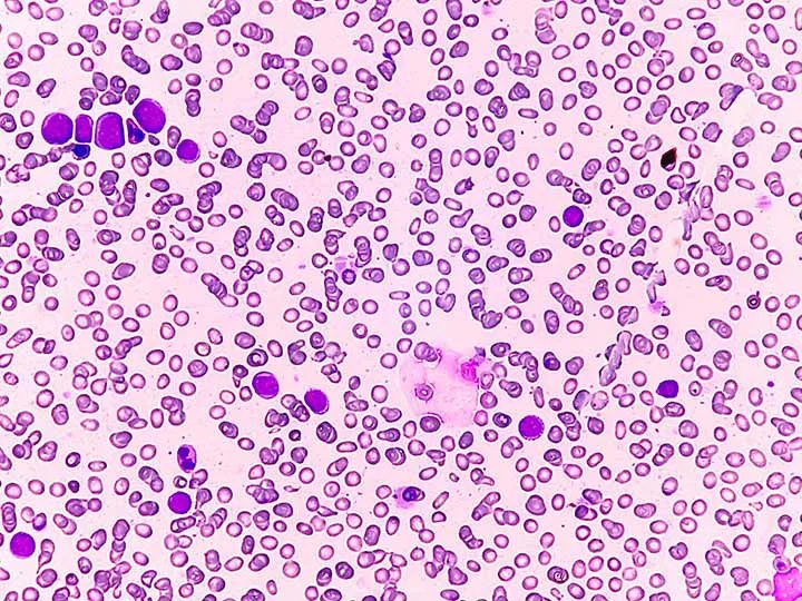 Two drugs that treat prostate cancer may also be effective against leukemia