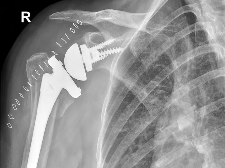 Risk indicators for hospital readmission after shoulder surgery in Pennsylvania
