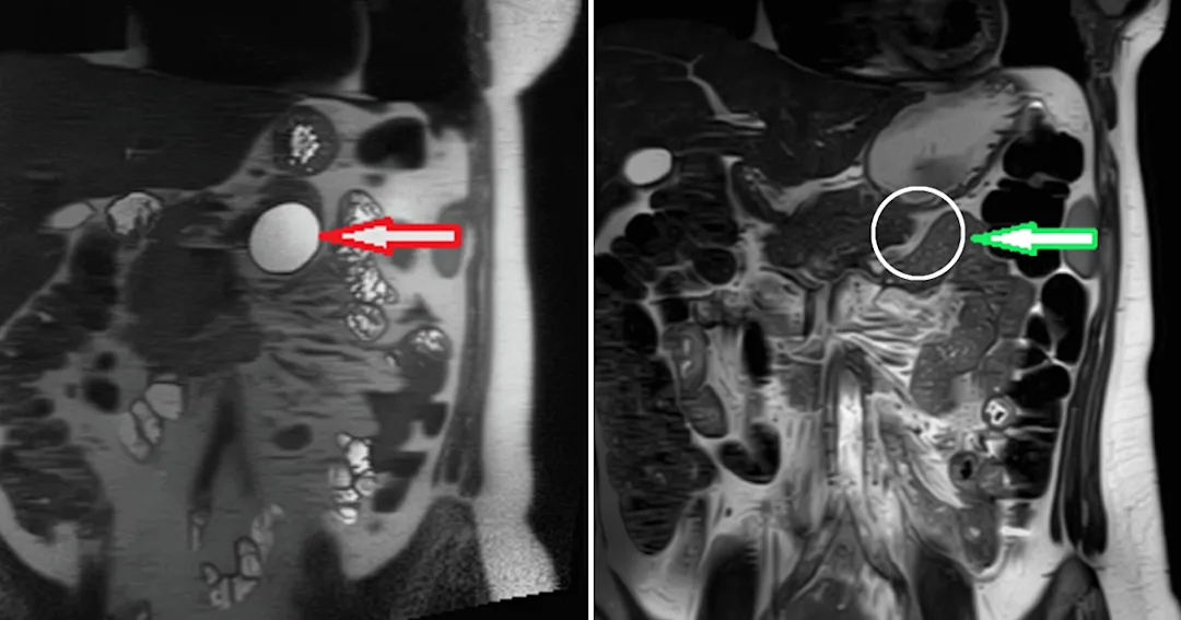 Two before and after MRI scans of a patient's pancreas showing a precancerous cyst and without a precancerous cyst.
