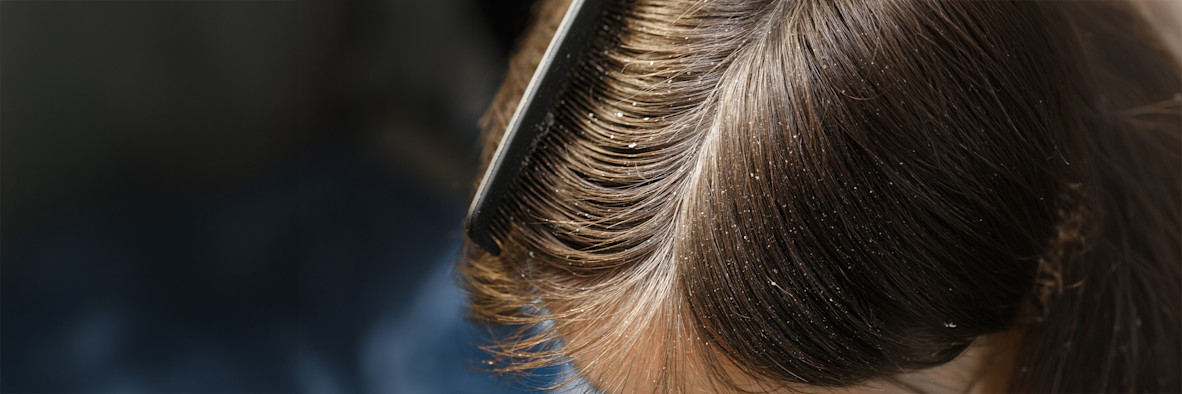 Primer plano extremo de mechones de cabello oscuro que muestra la superficie del cuero cabelludo en detalle.