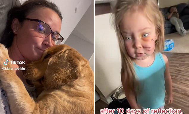 Mom faces backlash for keeping family's pet dog after it bit her three-year-old daughter's face