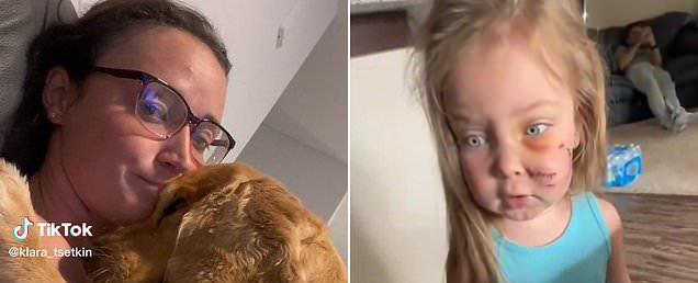 Mom faces backlash for keeping family's pet dog after it bit her three-year-old daughter's face