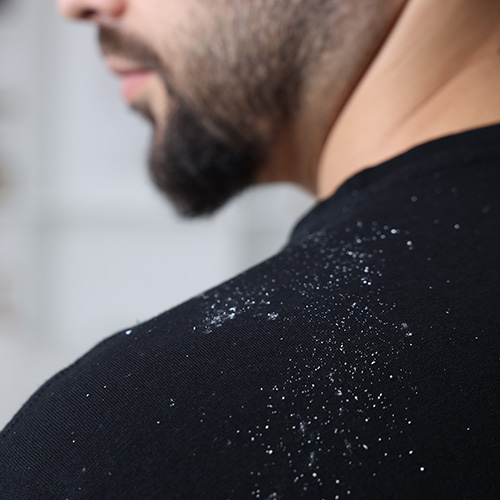 Un homme barbu en pull foncé avec des pellicules blanches visibles sur son épaule.