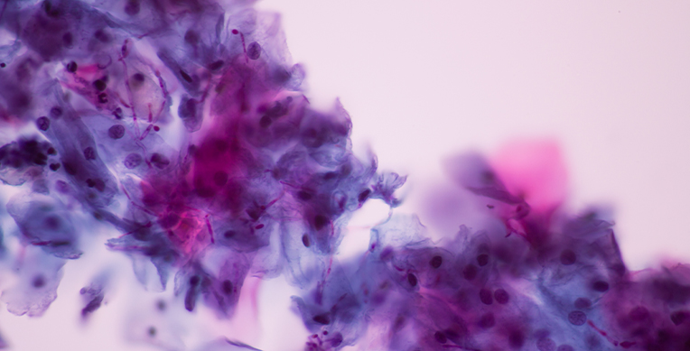 que-es-la-candidiasis-vaginal-nosotras-interior