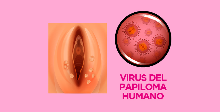 virus del papiloma humana)