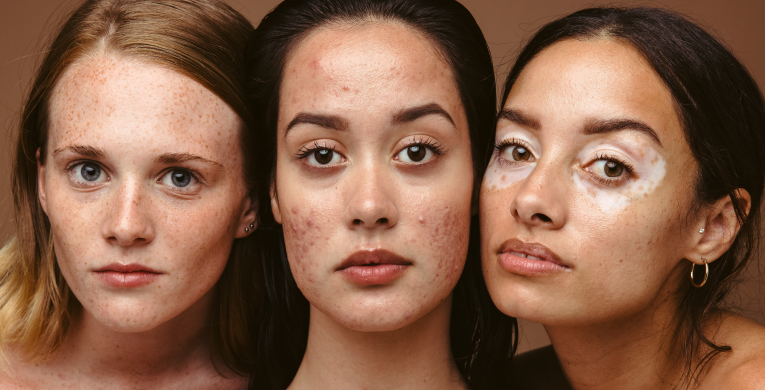 acne-hormonal-int-articulo-1