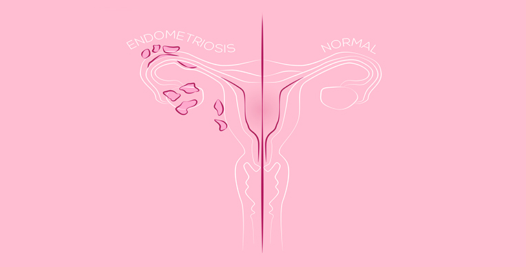 que-es-la-endometriosis-interna-1