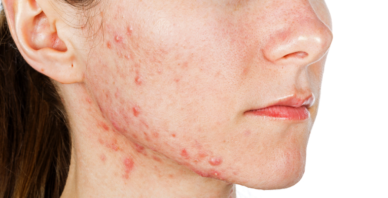 acne-hormonal-int-articulo-3