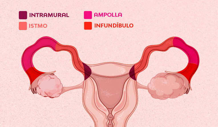 trompas-de-falopio-infografico-interna-1