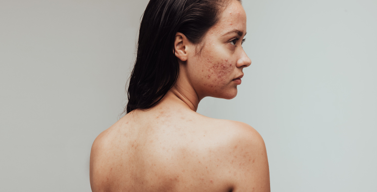 acne-hormonal-int-articulo-2