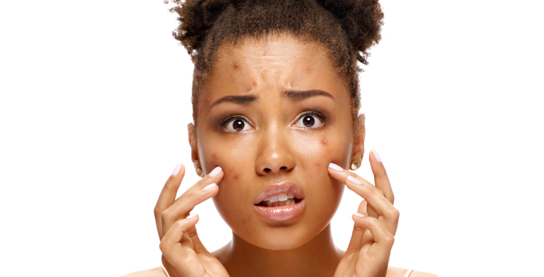 acne-hormonal-int-articulo-4