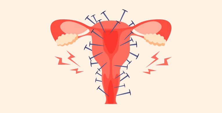 como-es-vivir-con-endometriosis-int-articulo-4