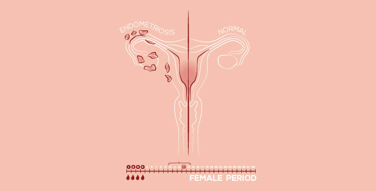 como-es-vivir-con-endometriosis-int-articulo-1