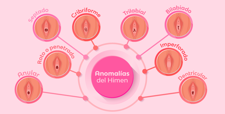 anomalias-del-himen-int-articulo-3