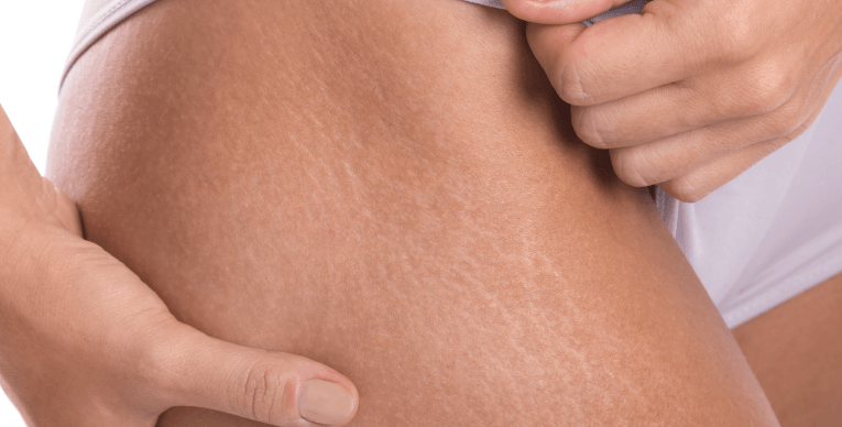 celulitis-estrias-interna1