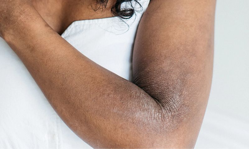  Image featuring an arm highlighting a dry skin condition