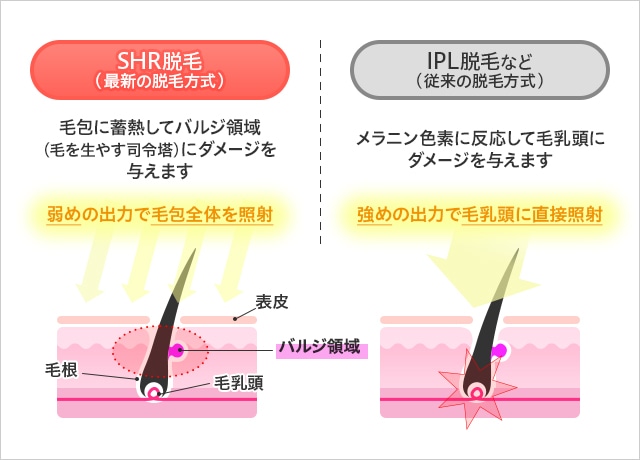 SHR脱毛と従来の脱毛の仕組みの違い