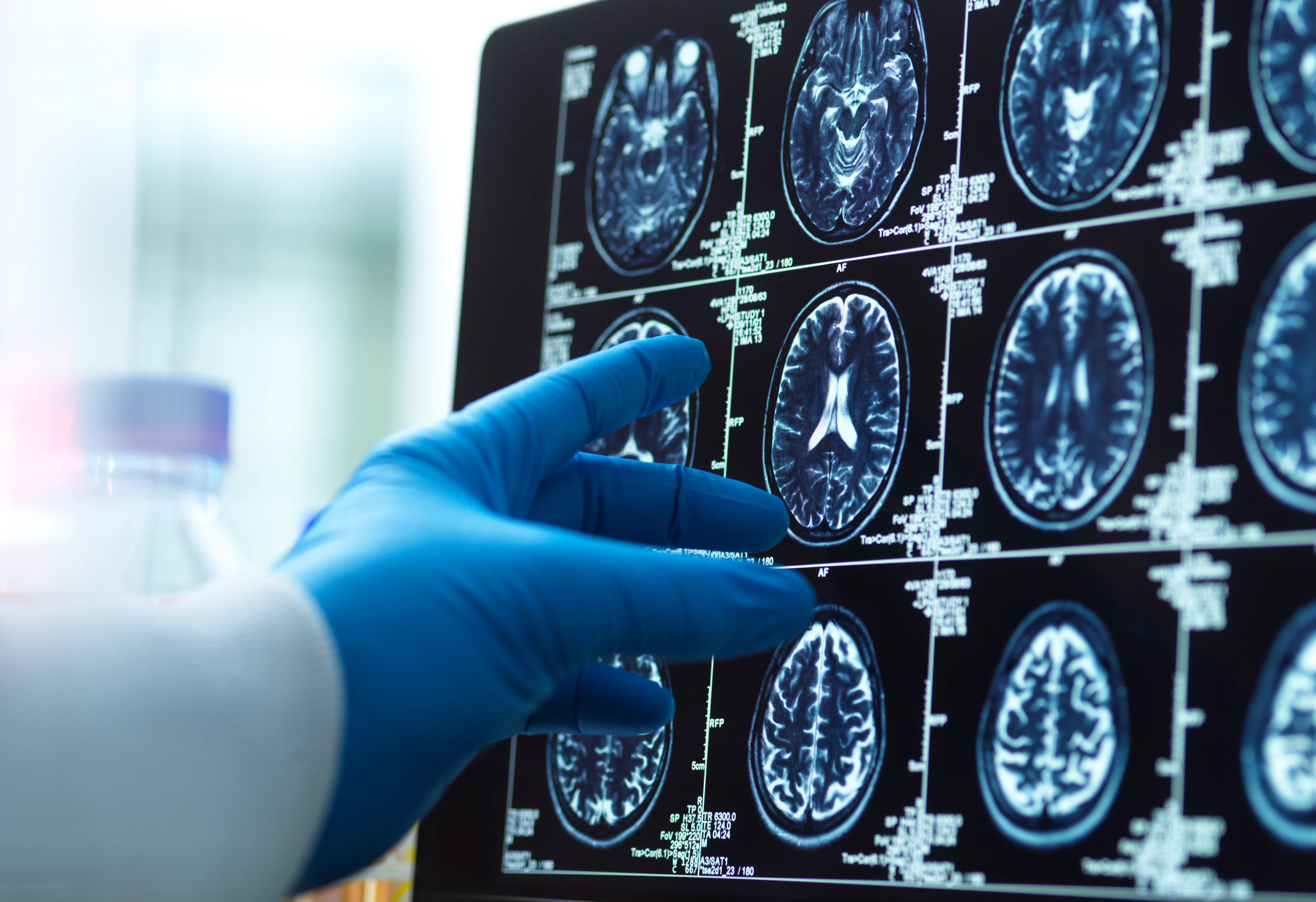 A doctor's hand in a blue glove pointing to a brain scan